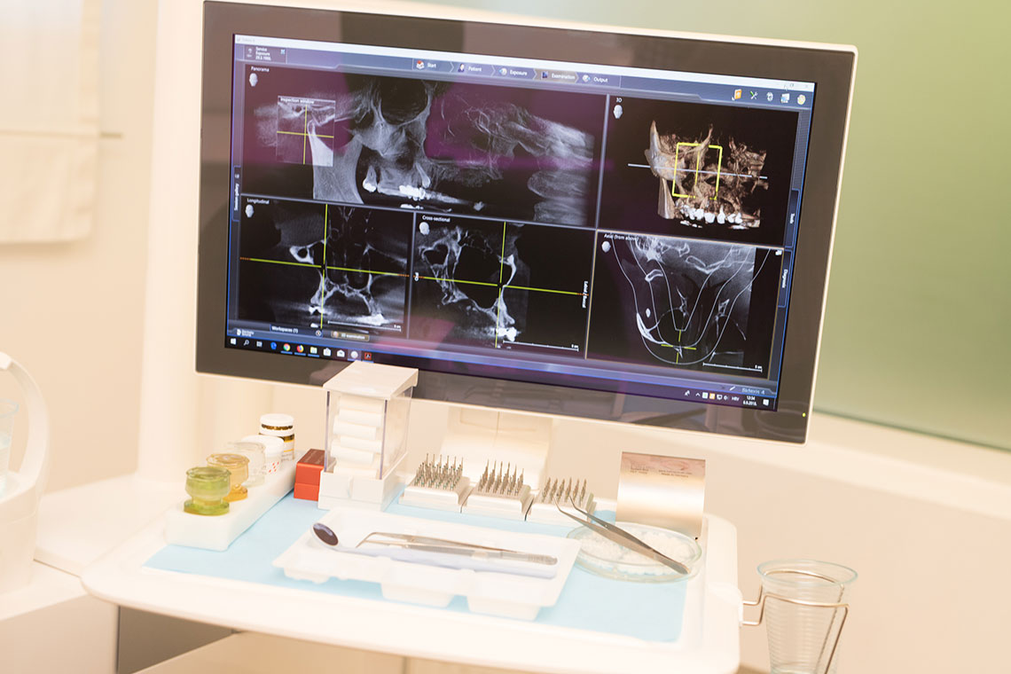 Terapija tvrdih tkiva u ustima – Ordinacija dentalne medicine Josip Siber, Osijek